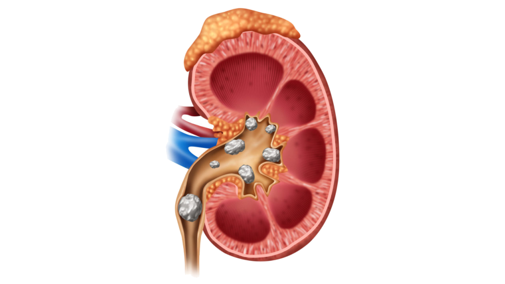 Böbrek Taşı: Neden Oluşur, Nasıl Tedavi Edilir?