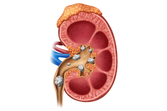Böbrek Taşı: Neden Oluşur, Nasıl Tedavi Edilir?